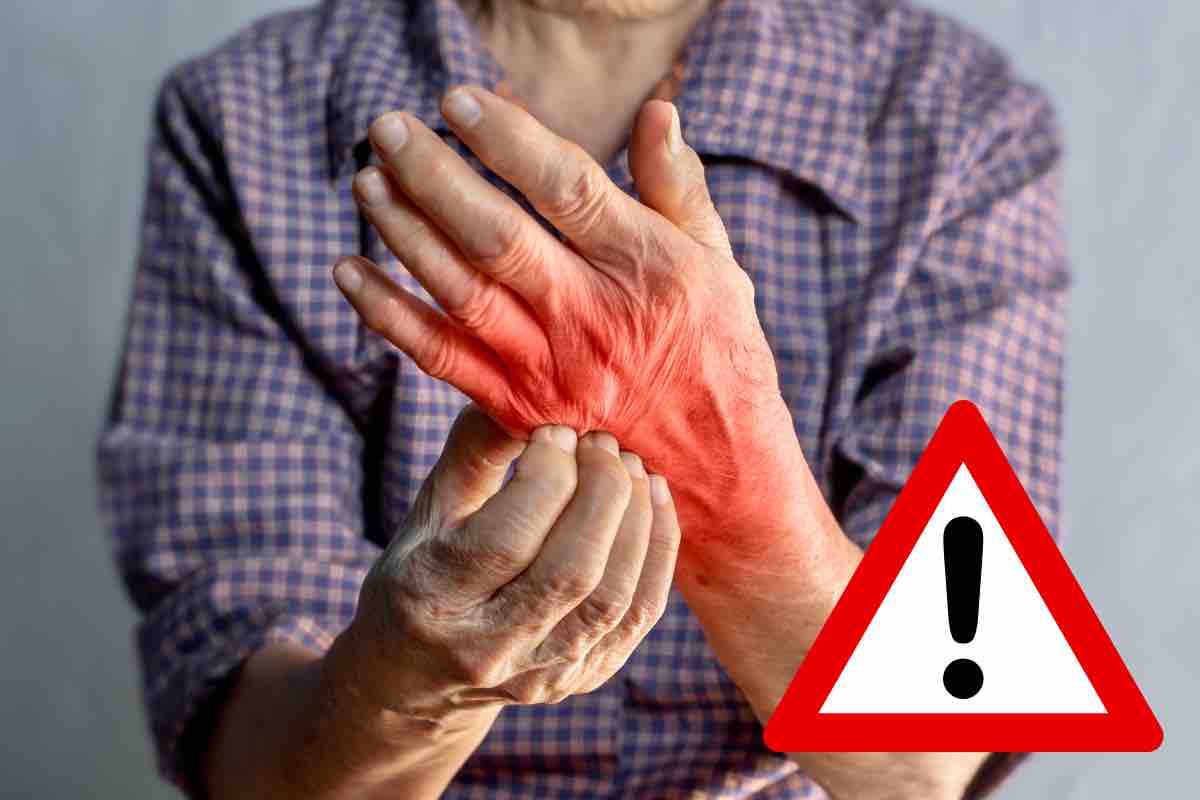 Aumenti di pazienti con la scabbia