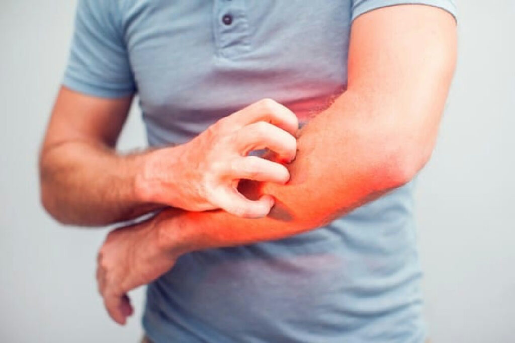 Prurito inspiegabile sulla pelle? Ecco perché molti sottovalutano possibili allergie alimentari